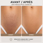 SKINIQO INGROWN FIX - le soin anti-poils incarnés.