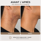 SKINIQO INGROWN FIX - le soin anti-poils incarnés.